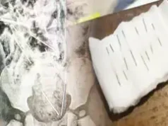 TARAPOTO: MÉDICOS SALVAN LA VIDA DE NIÑO DE DOS AÑOS QUE INGIRIÓ OCHO AGUJAS