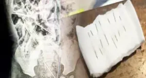 TARAPOTO: MÉDICOS SALVAN LA VIDA DE NIÑO DE DOS AÑOS QUE INGIRIÓ OCHO AGUJAS