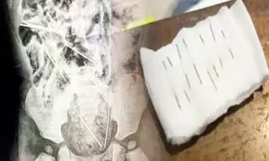 TARAPOTO: MÉDICOS SALVAN LA VIDA DE NIÑO DE DOS AÑOS QUE INGIRIÓ OCHO AGUJAS