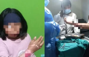 ¡TERRIBLE! MADRE QUEMA EL ANTEBRAZO DE SU HIJA POR TOMAR DINERO SIN SU PERMISO: PADRASTRO FUE COMPLICE