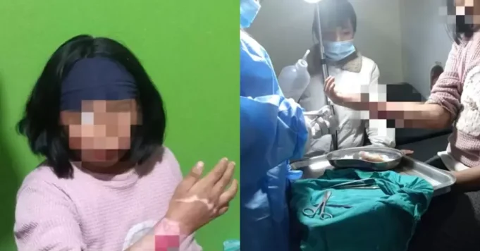 ¡TERRIBLE! MADRE QUEMA EL ANTEBRAZO DE SU HIJA POR TOMAR DINERO SIN SU PERMISO: PADRASTRO FUE COMPLICE