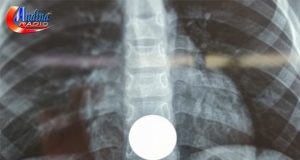 CHOTA: MEDICOS EXTRAEN MONEDA DE UN SOL QUE ATRAGANTO UN NIÑO DE 7 AÑOS