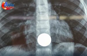 CHOTA: MEDICOS EXTRAEN MONEDA DE UN SOL QUE ATRAGANTO UN NIÑO DE 7 AÑOS