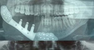 HOSPITAL NACIONAL DOS DE MAYO REALIZA PRIMER IMPLANTE DE TITANIO EN MANDIBULA.