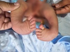EXITOSA CIRUGIA EN EL HOSPITAL JOSE SOTO CADENILLAS A NIÑO DE UN MES QUE NACIO CON MALFORMACION EN LAS PIERNAS