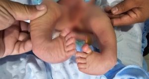 EXITOSA CIRUGIA EN EL HOSPITAL JOSE SOTO CADENILLAS A NIÑO DE UN MES QUE NACIO CON MALFORMACION EN LAS PIERNAS