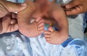 EXITOSA CIRUGIA EN EL HOSPITAL JOSE SOTO CADENILLAS A NIÑO DE UN MES QUE NACIO CON MALFORMACION EN LAS PIERNAS