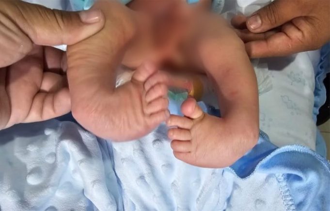 EXITOSA CIRUGIA EN EL HOSPITAL JOSE SOTO CADENILLAS A NIÑO DE UN MES QUE NACIO CON MALFORMACION EN LAS PIERNAS